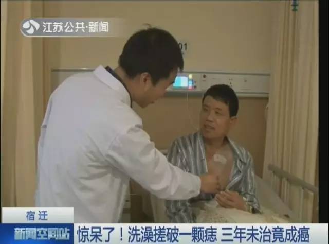 男子洗澡搓破一顆痣 3年未治竟成癌