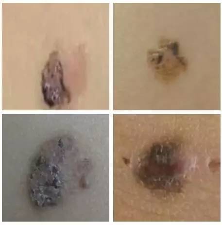 男子洗澡搓破一顆痣 3年未治竟成癌