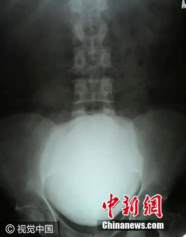印度男子腹痛入院 膀胱取出1.5公斤巨型結(jié)石