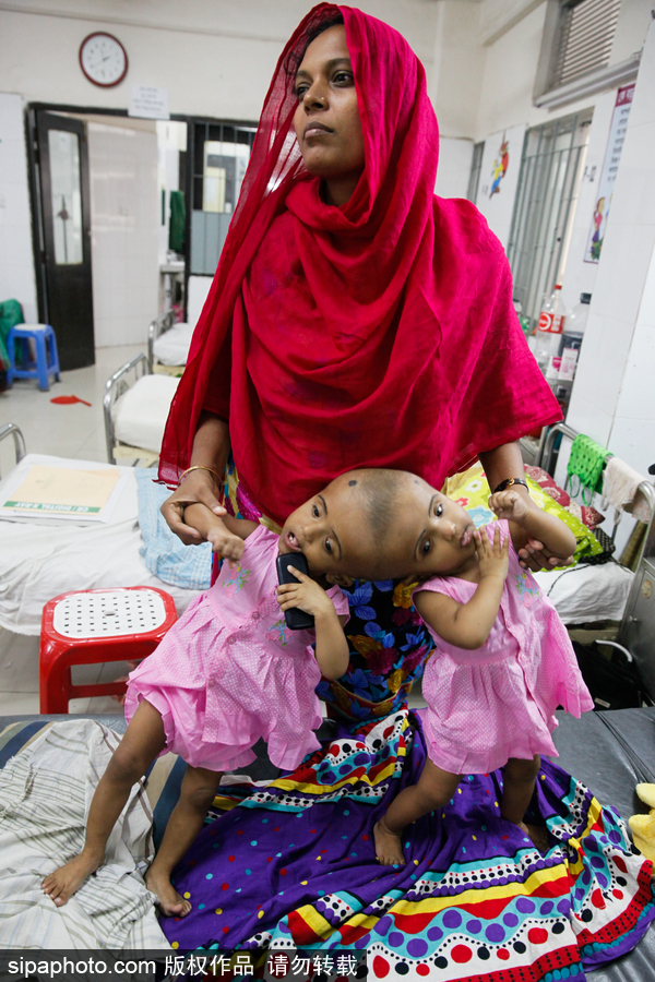 孟加拉國連頭嬰兒 至少到兩歲才能進行手術(shù)